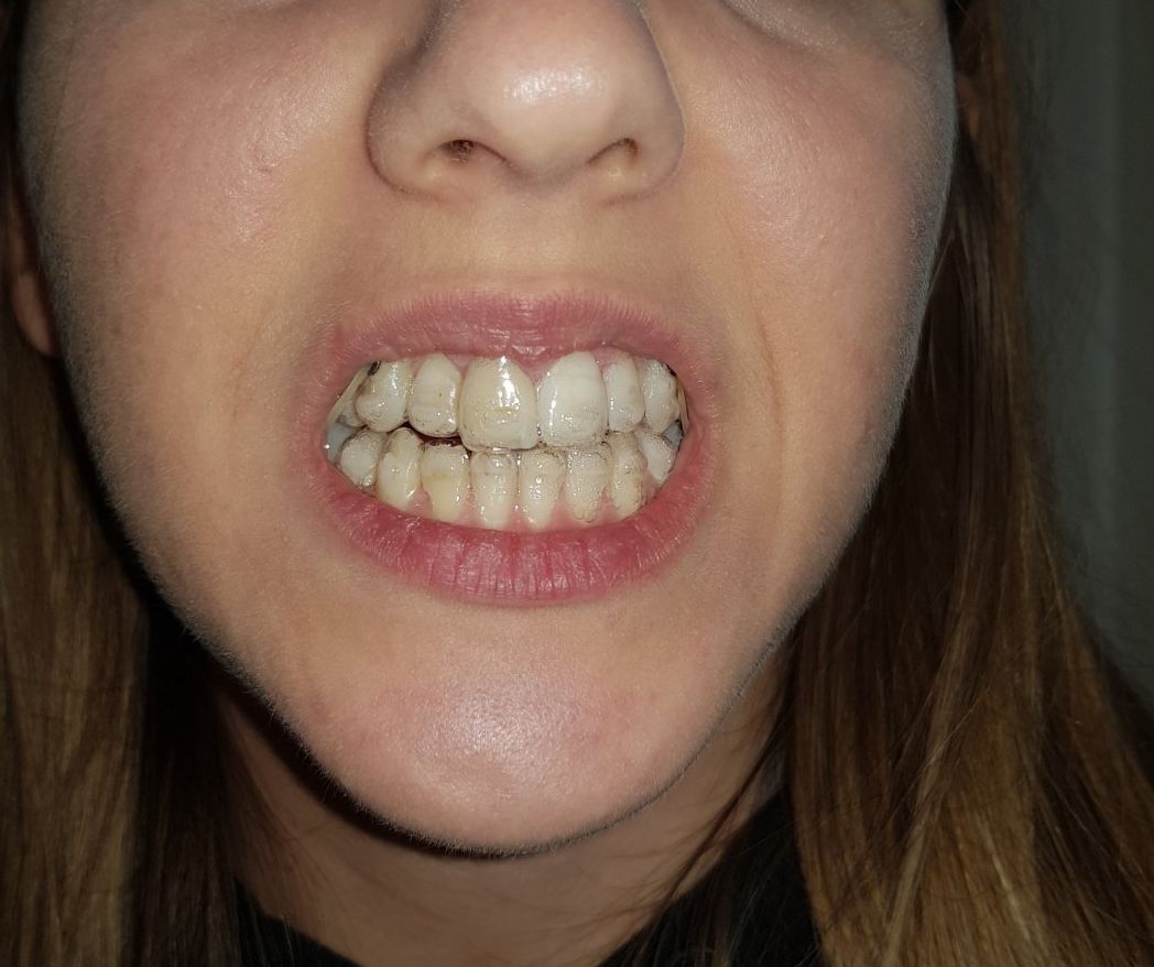 invisalign